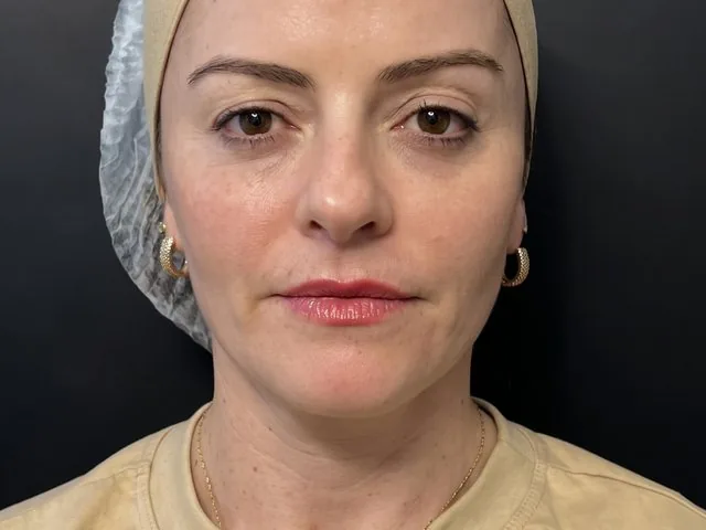 Perfil facial equilibrado após preenchimento full face